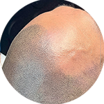 Scalp